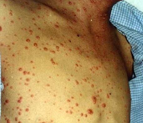 病毒性疱疹可以吃凉瓜吗,病毒性疱疹患者适宜食用凉瓜  第2张